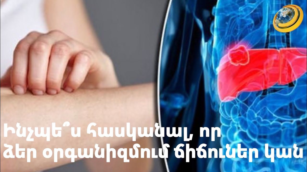 Ինչպե՞ս հասկանալ, որ ունեք քթային դժվարաշնչություն, և որքանո՞վ են վտանգավոր ադենոիդները, պոլիպները, քթի միջնապատի դեֆորմացիաները։